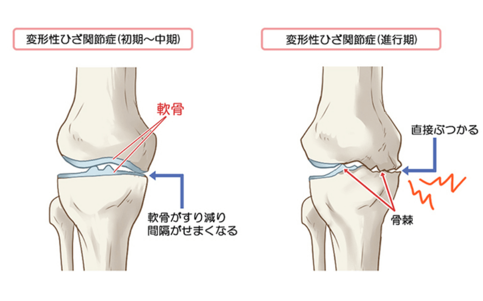 変形性膝関節症